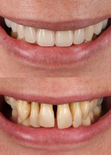 Augšžokļa visu zobu atjaunošana. UZ 6 implantiem balstīta konstrukcija. Tūlītēja slogošana.