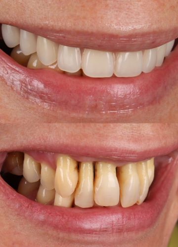 Augšžokļa visu zobu atjaunošana. UZ 6 implantiem balstīta konstrukcija. Tūlītēja slogošana.